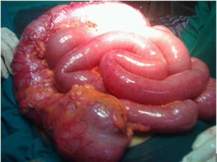 malignant large bowel obstruction